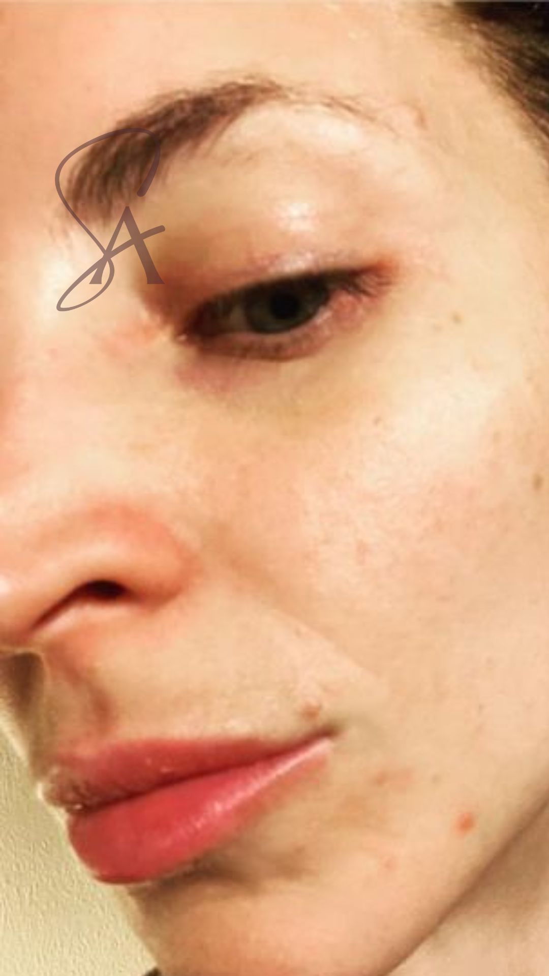 Close view of a patient's skin texture in the treatment room.