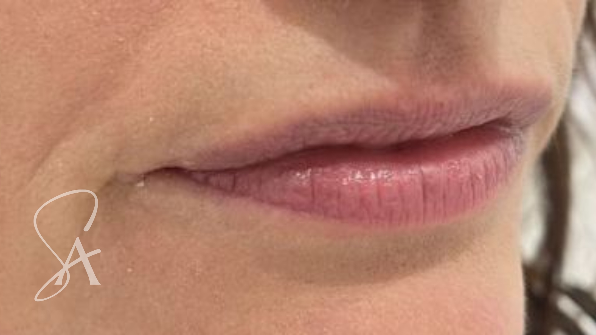 Before lip filler: the patient's lips with a flatter upper lip and fine vertical lines.