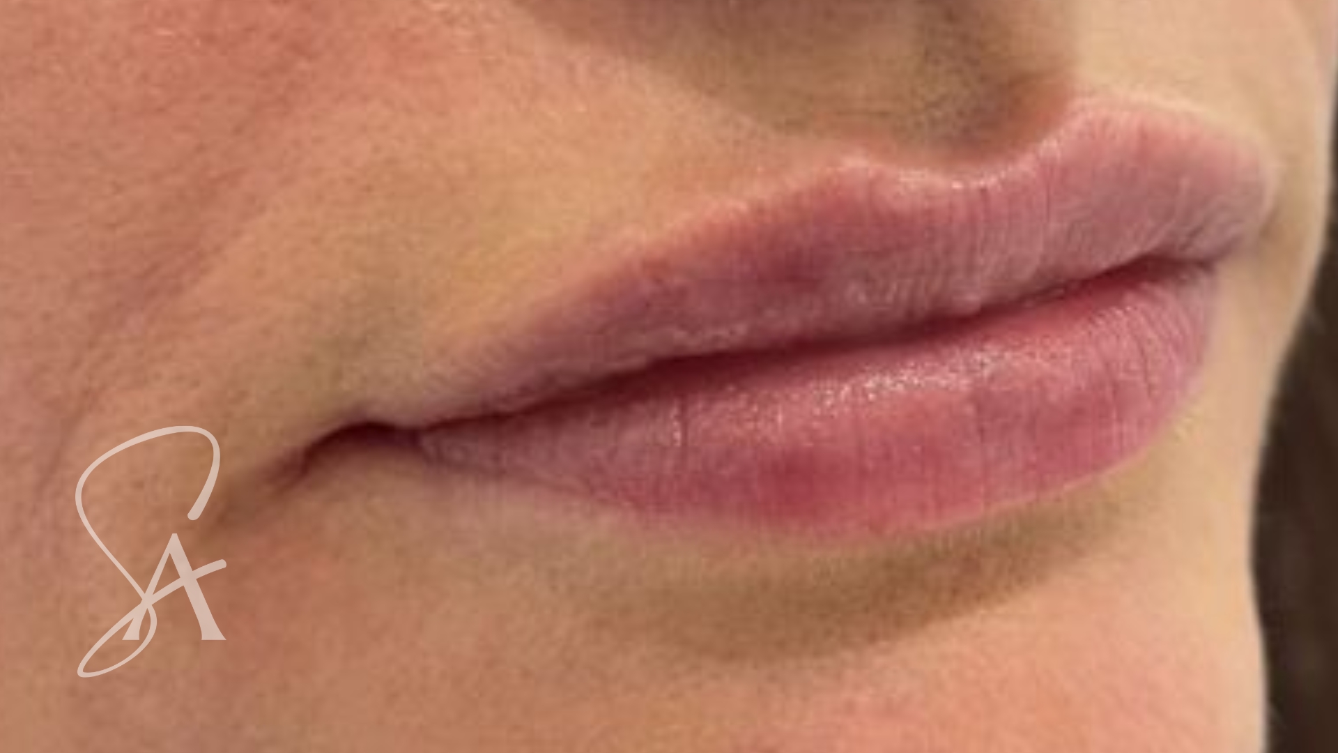 After lip filler: the same patient's lips, fuller and smoother with a defined border and Cupid's bow.