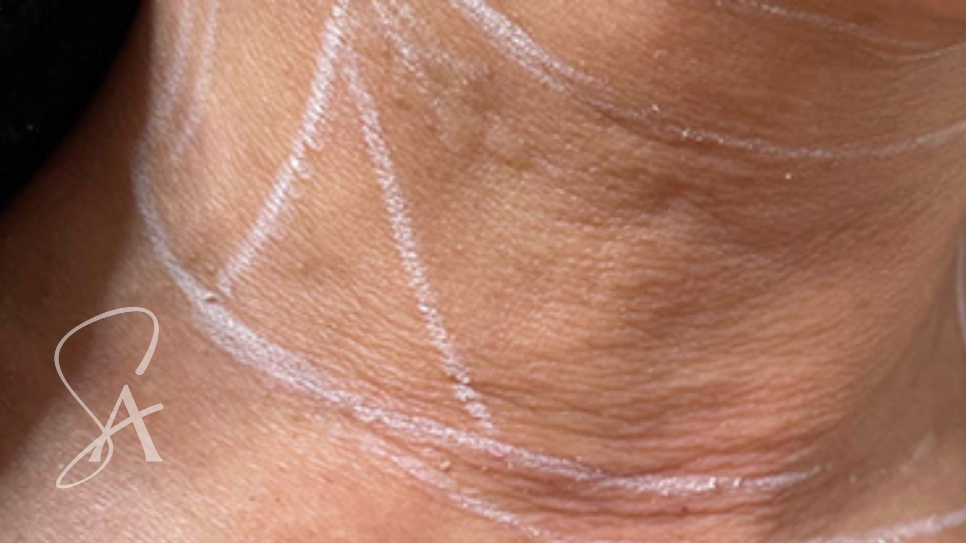 A neck marked with treatment guide lines in the clinic.