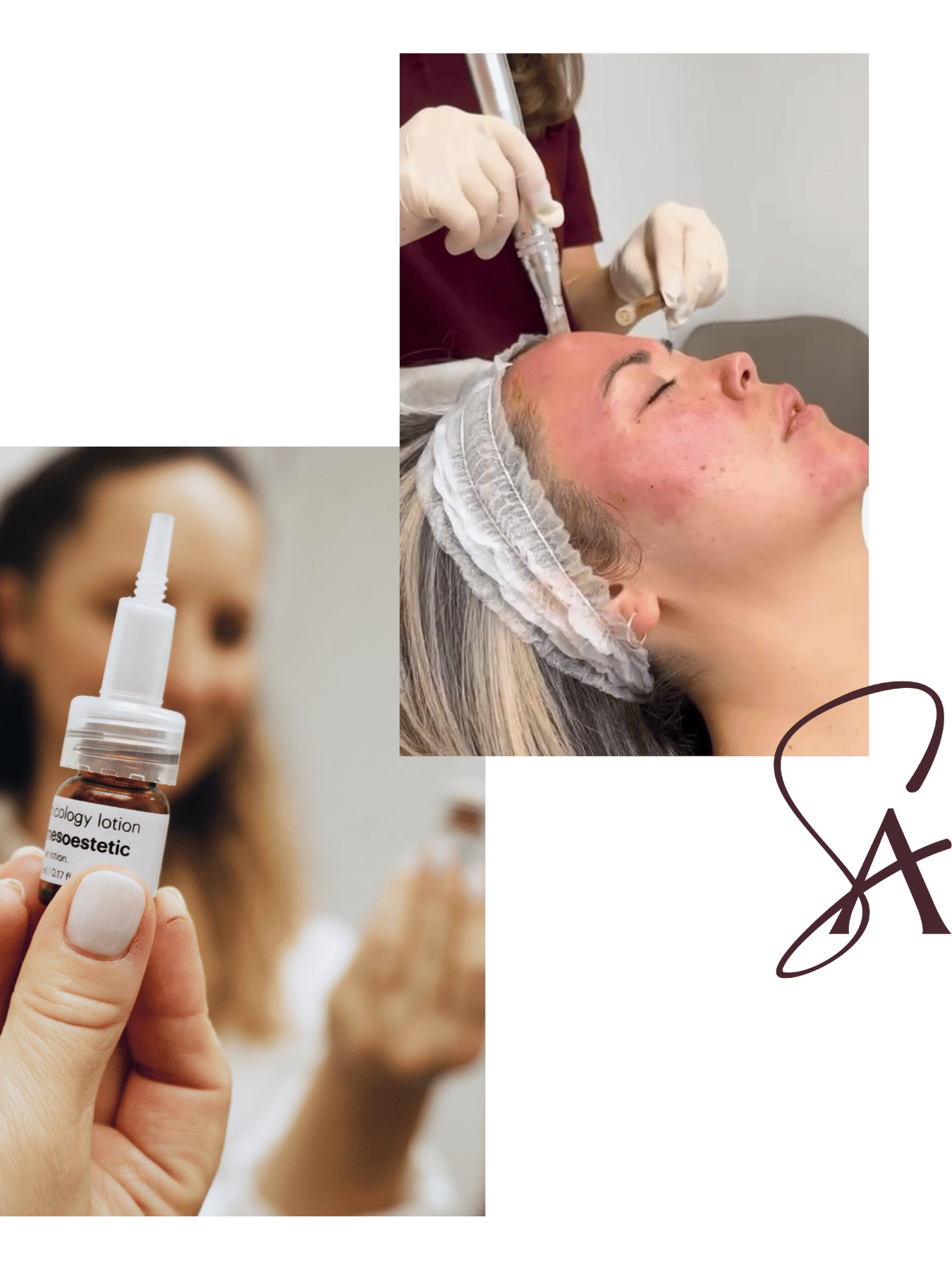 Microneedling treatment at Sian Aesthetics
