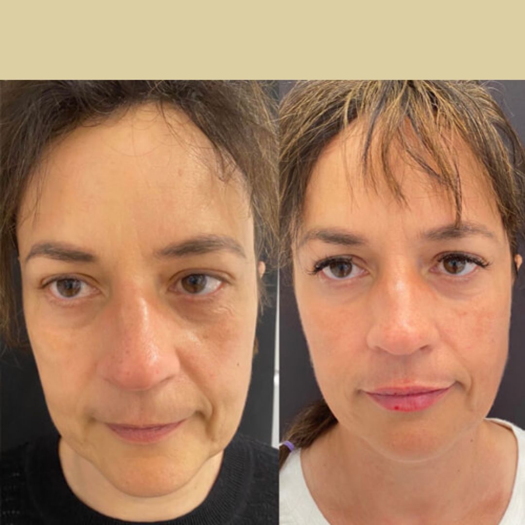 Before and after dermal filler: the same patient's full face, with restored cheek and mid-face volume and softer folds.