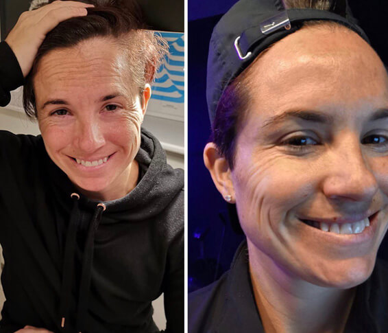 Before and after Profhilo: the same patient with brighter, more hydrated skin.