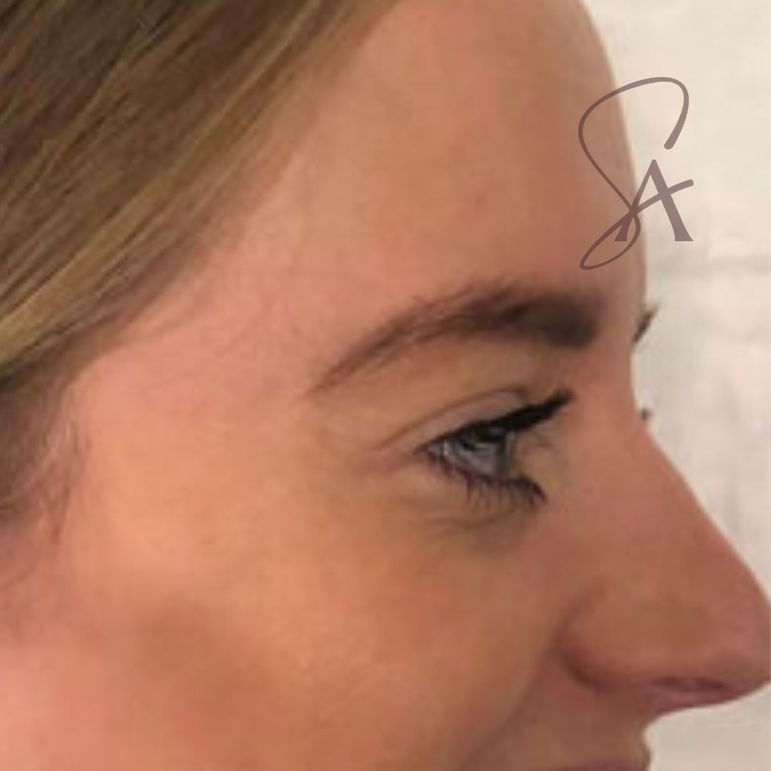 A close-up of the same patient's face - she has visibly improved skin without crows feet deep lines.