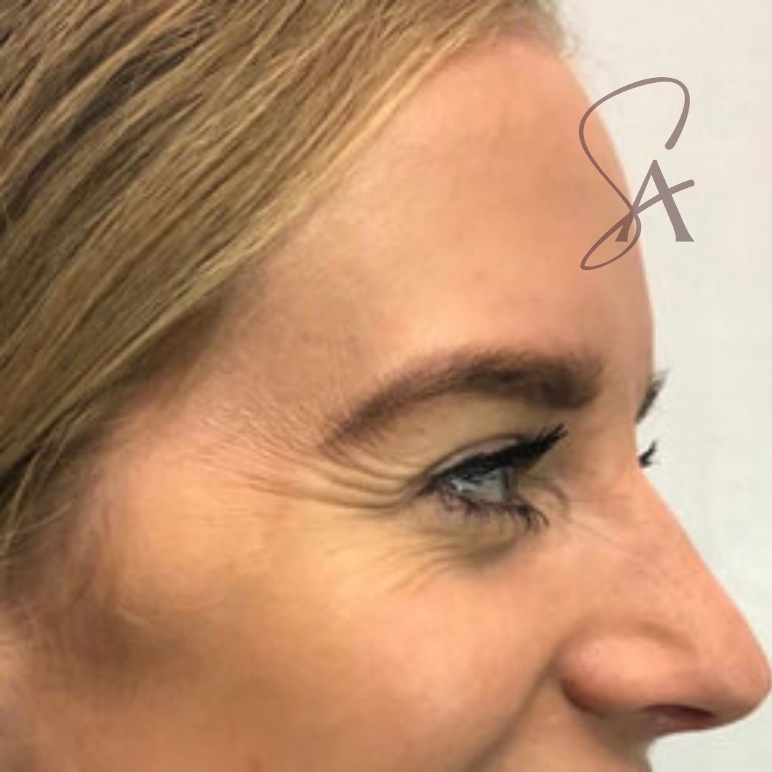 A close-up of a patient's face - she has visible crows feet around her eye. .