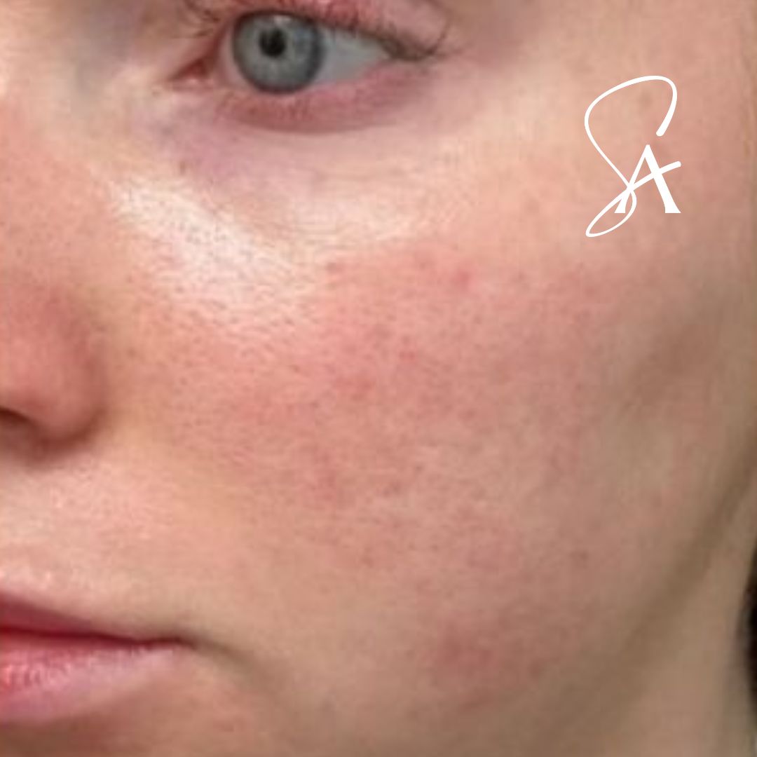 Before microneedling: a close view of a patient's cheek with uneven texture.
